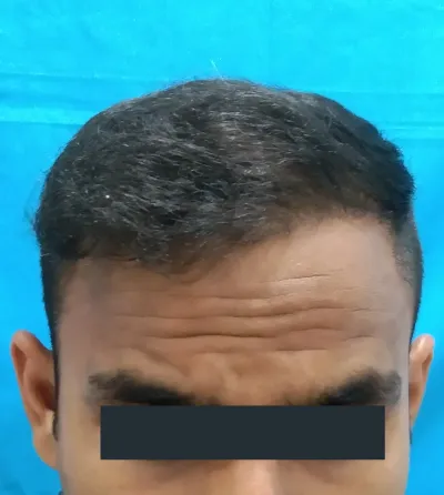 Activated Follicular Transplant Result After in VCare